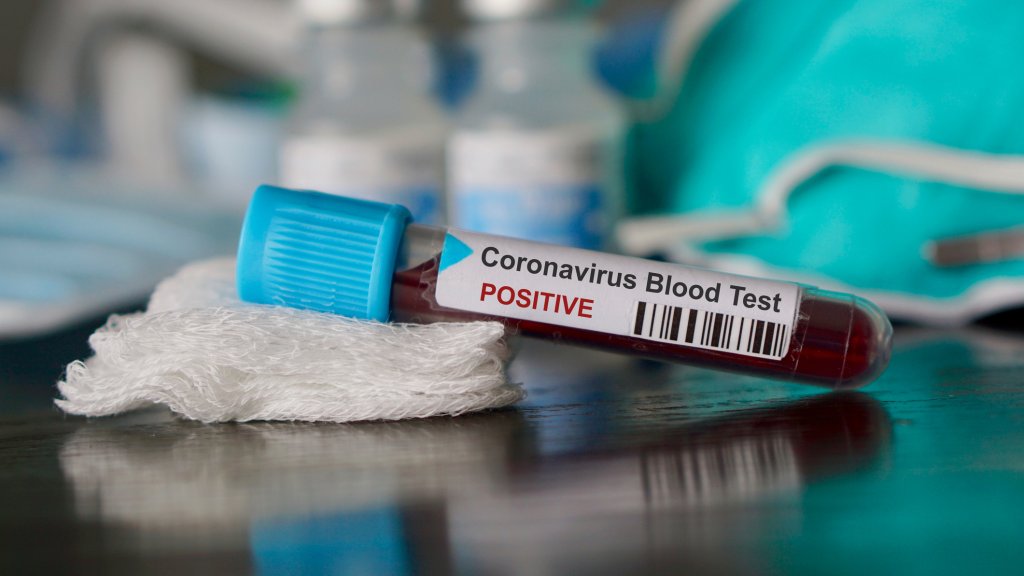 Die Parallelen zwischen Corona-Virus und HIV