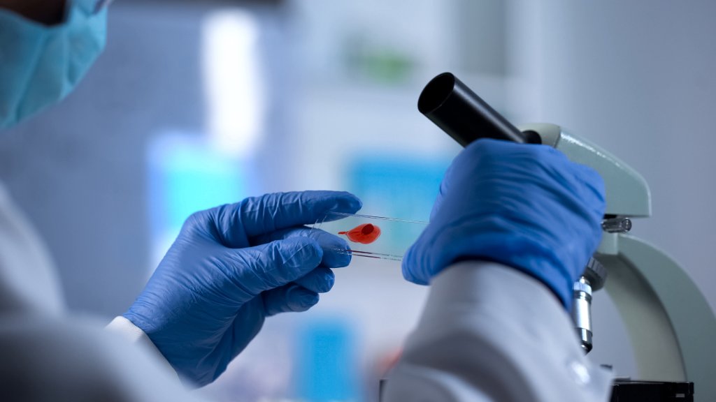 Neue Heilungsansätze, aber nicht für viele HIV-Patienten geeignet