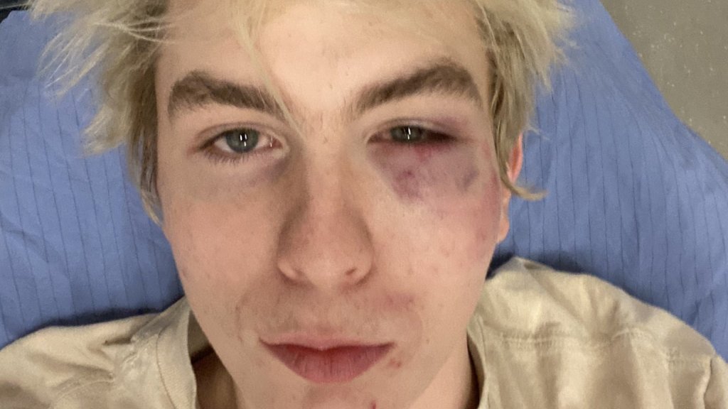 Kanadischer Student auf Party krankenhausreif geprügelt 