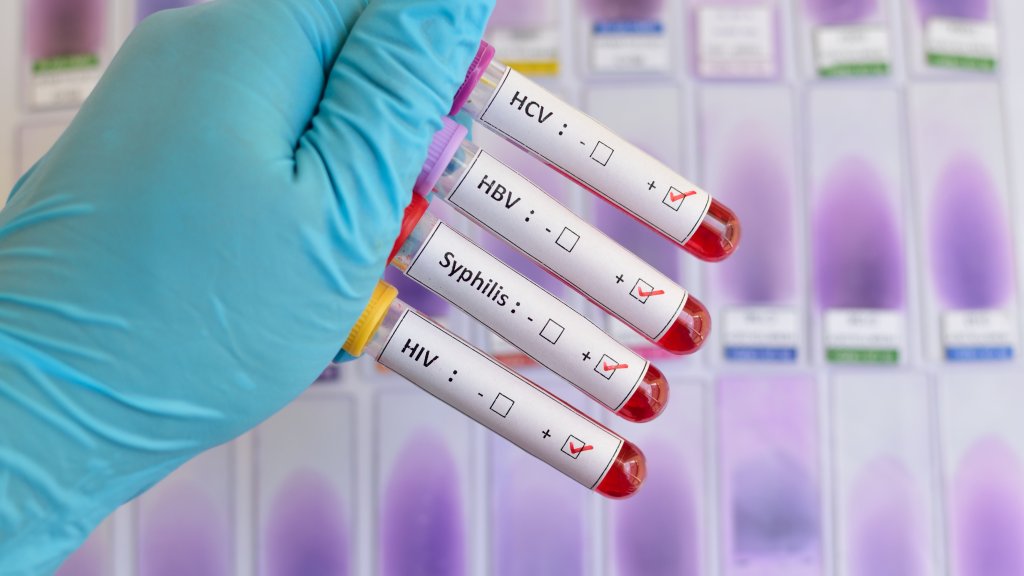 Frankreich macht STI-Tests für junge Menschen kostenlos