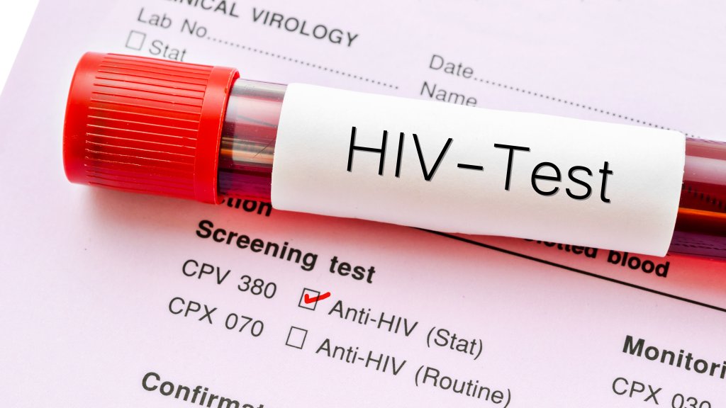 Ende von HIV-Tests im Job?