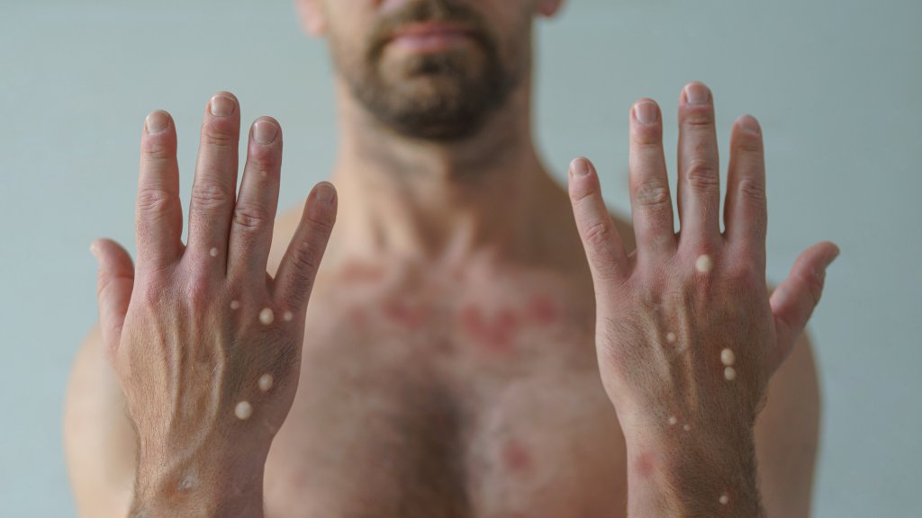 Affenpocken und HIV