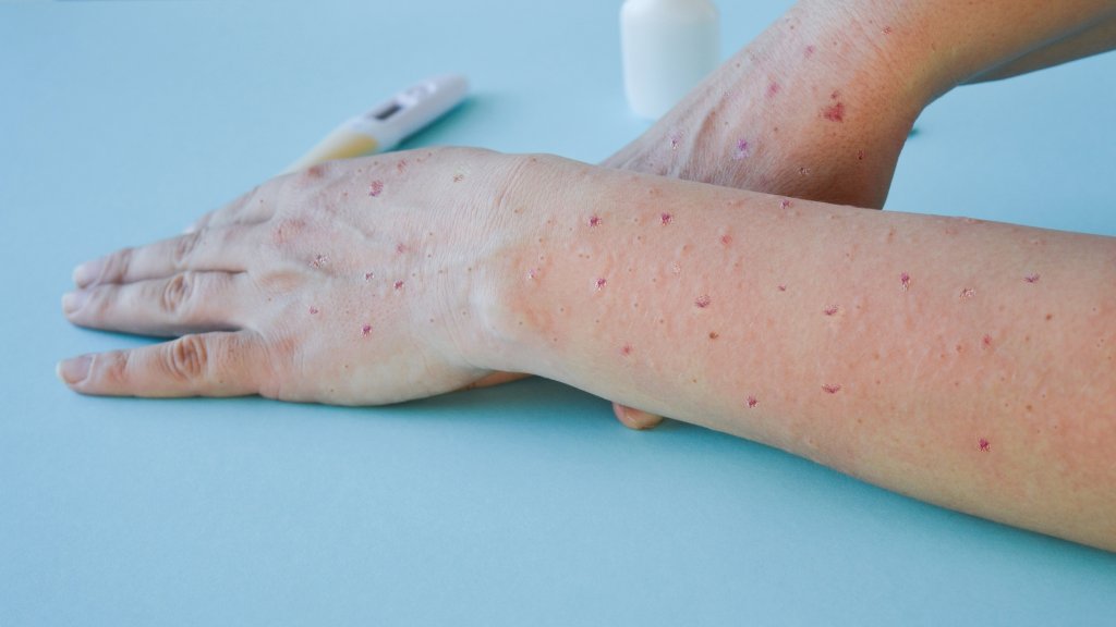 Mpox in Russland