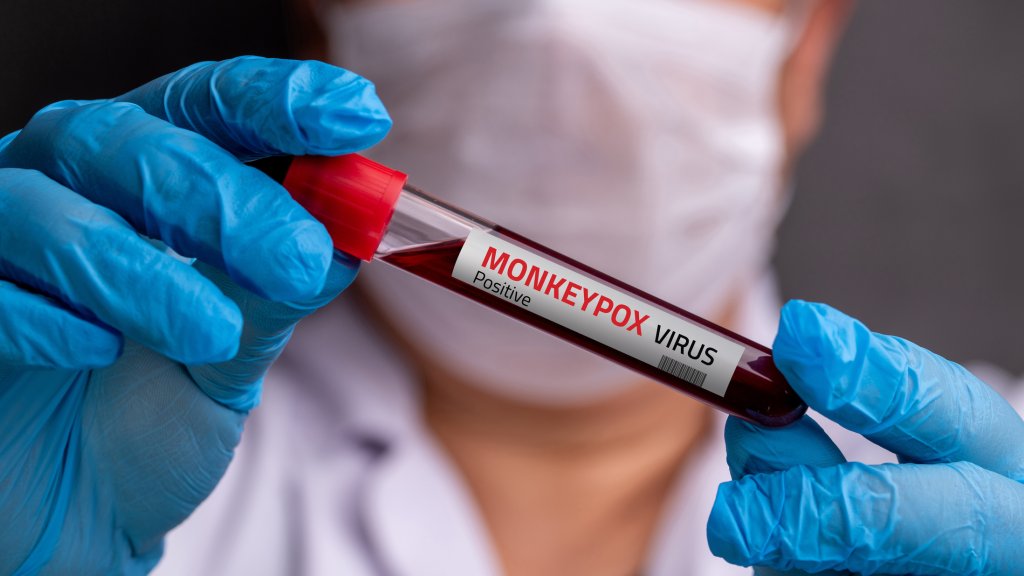 Sorge um Mpox in den USA