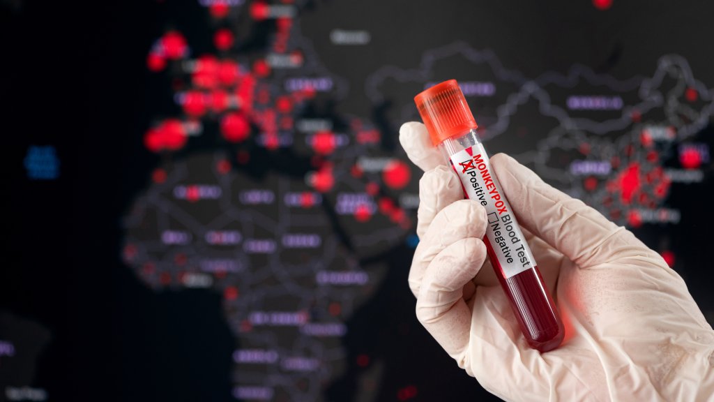 Neue Erkenntnisse zu Mpox 