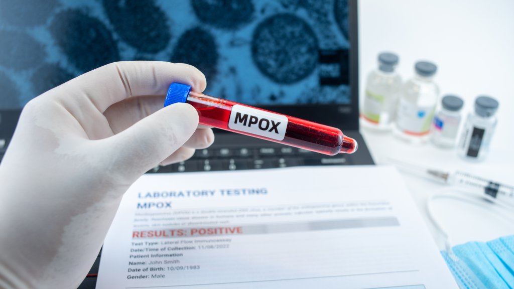 Mpox in der Schweiz 