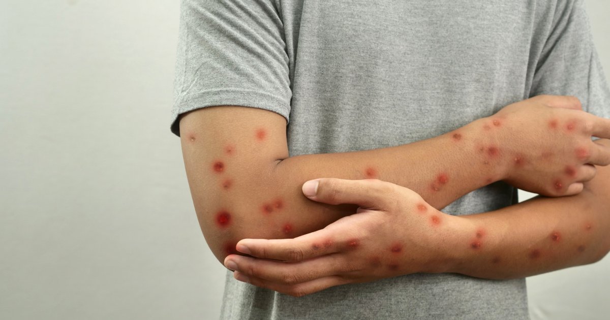 Mpox-Hotspot-Berlin-Gr-tenteils-schwule-und-bisexuelle-M-nner-betroffen