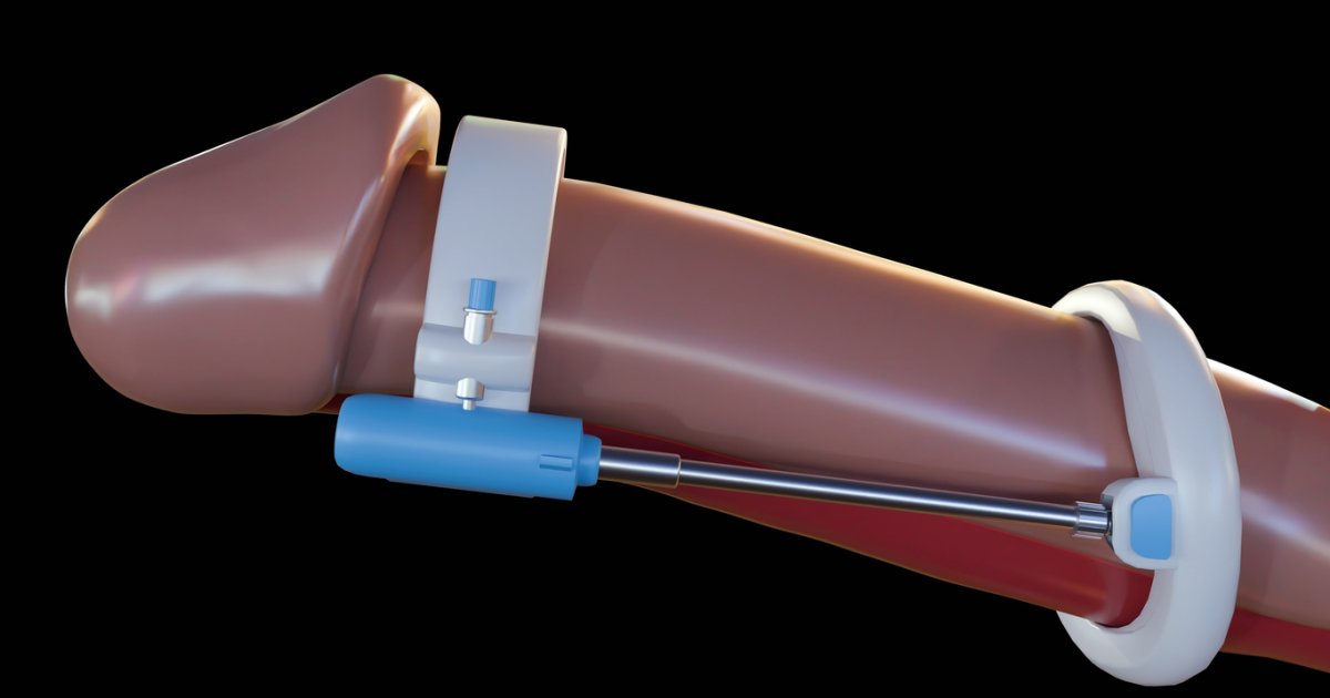 Warum-schweigen-M-nner-ber-ihre-Sorgen-Ist-Penisvergr-erung-ein-Tabu-Thema-