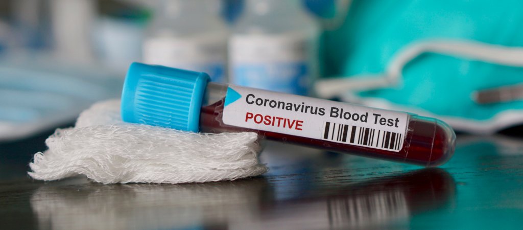 Die Parallelen zwischen Corona-Virus und HIV