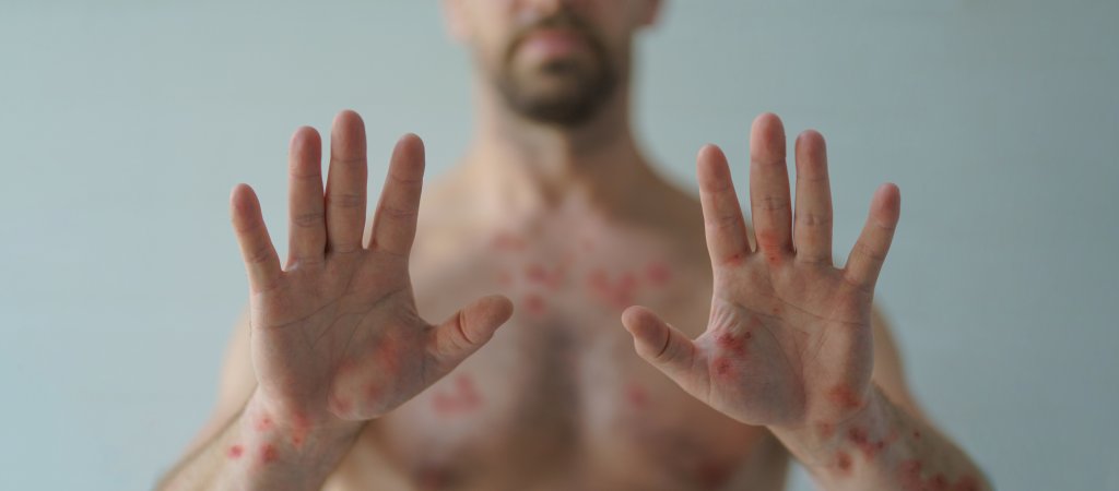 Die Affenpocken sind noch nicht weg... // © Halfpoint