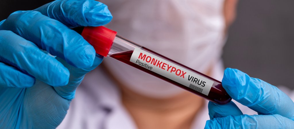 Sorge um Mpox in den USA