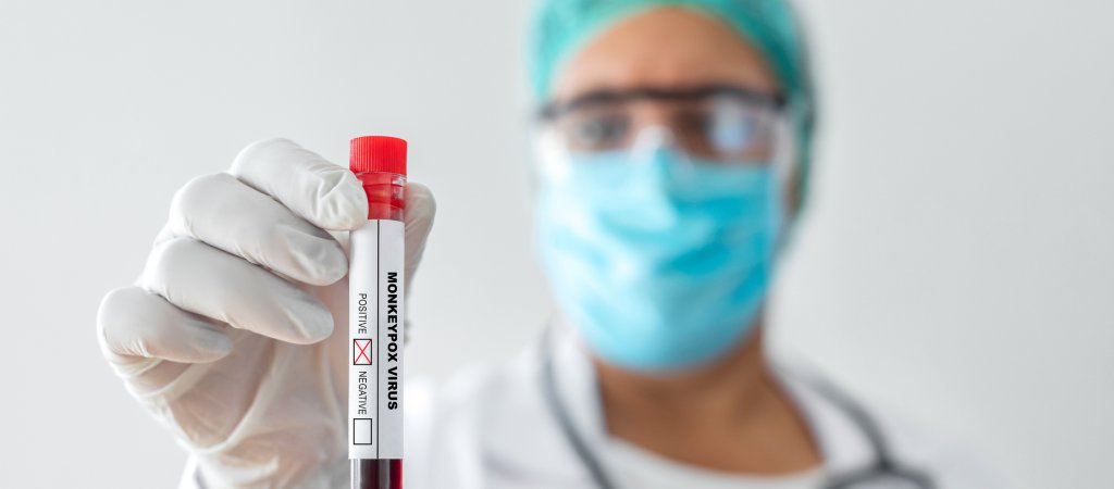 Neue Mpox-Variante in Österreich 