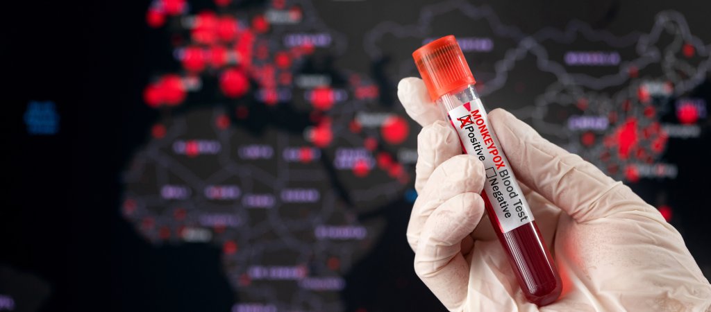 Neue Erkenntnisse zu Mpox 