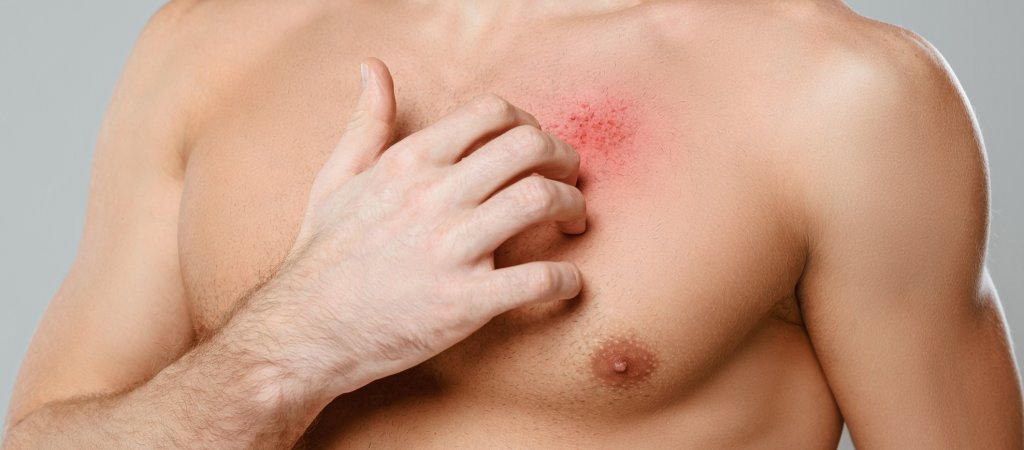 US-Ärzte warnen vor neuer Pilz-STI 