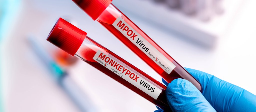 Mpox in Nordirland 