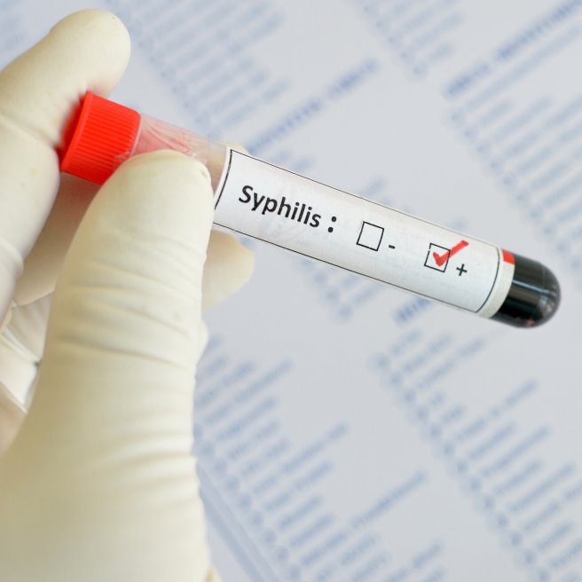 Neuer Anstieg der Syphilis-Fälle
