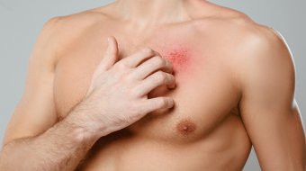 US-Ärzte warnen vor neuer Pilz-STI 