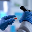 Neue Heilungsansätze, aber nicht für viele HIV-Patienten geeignet
