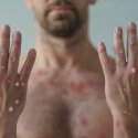 Affenpocken und HIV
