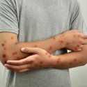 Bessere Mpox-Aufklärung