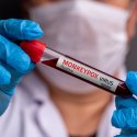 Sorge um Mpox in den USA