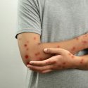 Mpox-Hotspot Berlin 